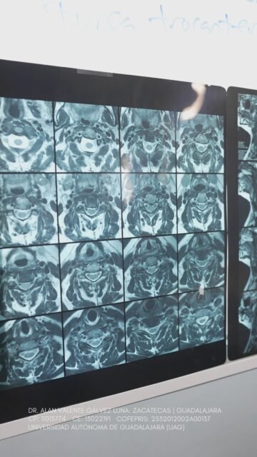 La mínima invasión no solo busca aliviar el dolor, también ayudarte a recuperar movimiento y calidad de vida. 🩺✨ Agenda tu valoración y conoce las opciones para tu caso. 📩 

Dr. Alan Valente Gálvez Luna
⚕️Especialista en Medicina del Dolor e intervencionismo Avanzado en Algologia
📍 Instituto Oncológico Nacional- ION Colomos
Av. Patria 2945- Zapopan
📍 Hospital Santa Fe , consultorio 109
Cráter 10, Guadalupe, Zacatecas
📞 Guadalajara:  33 2726 1907
📞 Zacatecas: 492 264 8689
UNIVERSIDAD AUTÓNOMA DE GUADALAJARA| UAG
CP: 11015774| CE: 13022191|
COFEPRIS Santa Fe: 2532012002A00137
COFEPRIS GDL Instituto ION: 2514102002A00839